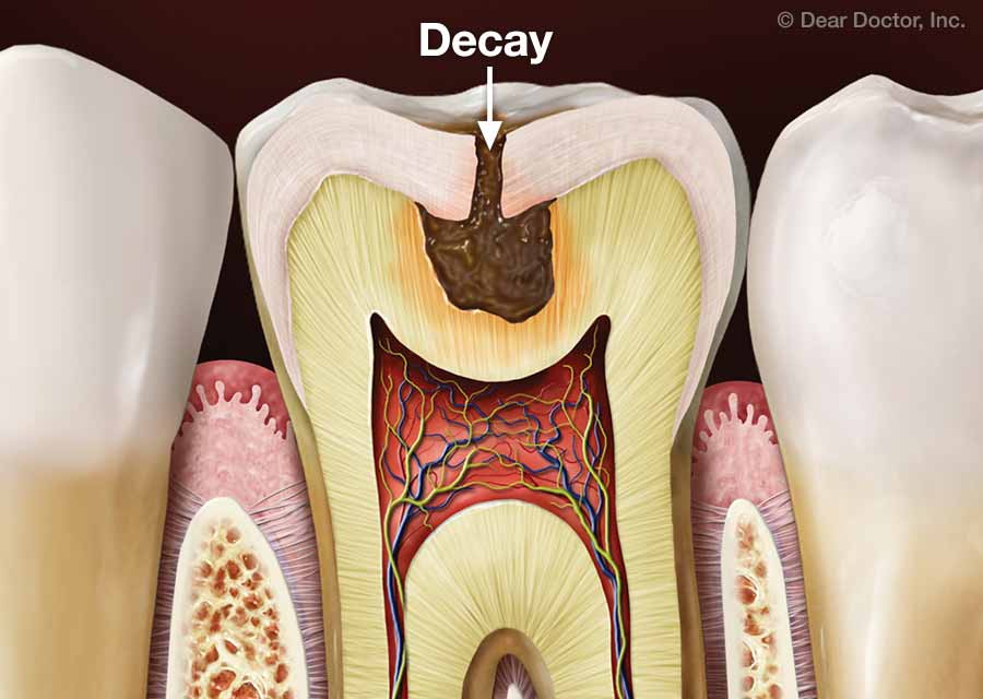 tooth-decay.jpg