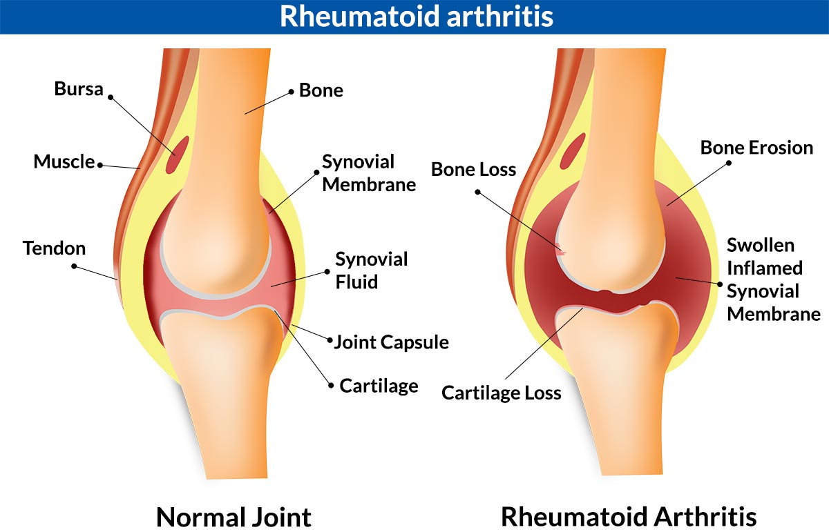 rheumotoid_Arthritis