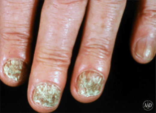 ringworm-nail-infection-several-symptoms